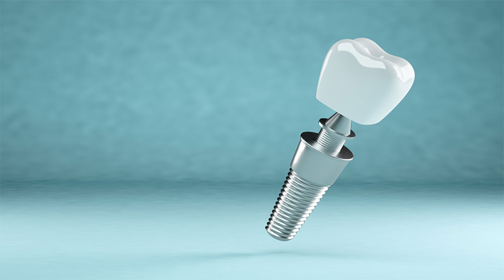 The Future of Dental Implants