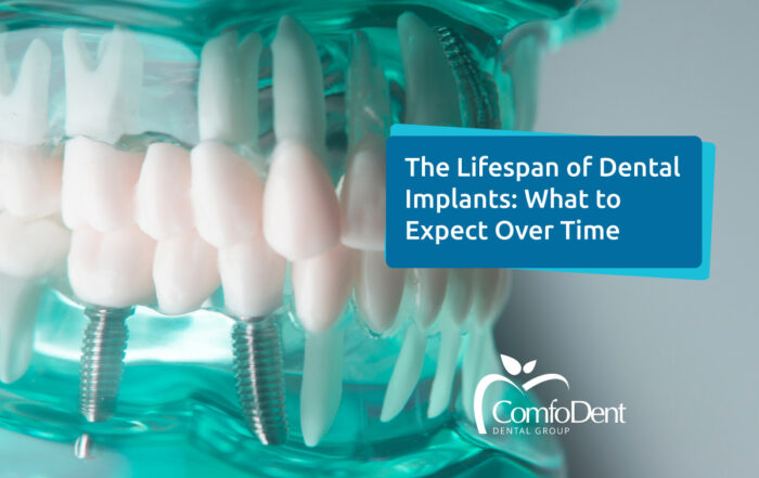 The Lifespan of Dental Implants