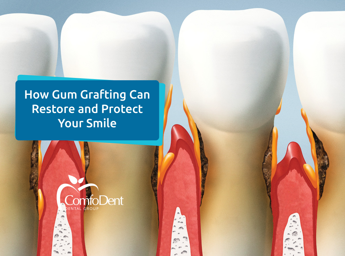 How Gum Grafting Can Restore and Protect Your Smile