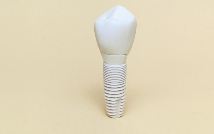 The Rise of Ceramic Implants