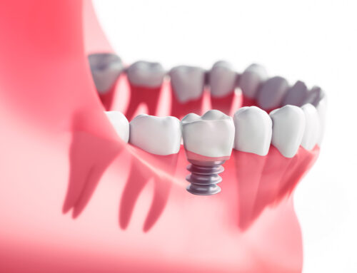 The Role of Short Dental Implants in Modern Dentistry