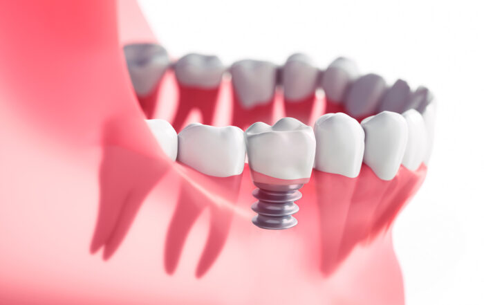 The Role of Short Dental Implants in Modern Dentistry